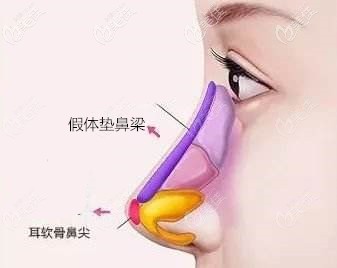 隆鼻假體墊鼻梁+耳軟骨墊鼻尖