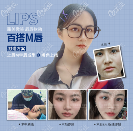 重慶鄭荃麗格做M唇效果怎么樣 重慶鄭荃麗格做M唇效果怎么樣