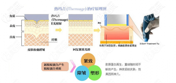熱瑪吉又名塑美極(Thermage)的治療原理 熱瑪吉又名塑美極(Thermage)的治療原理