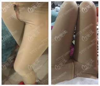 在北京做完大腿環(huán)吸第21天