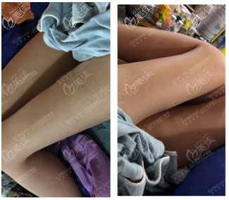 <!--<i data=20240703-sp></i>-->給我做大腿環(huán)吸45天案例效果