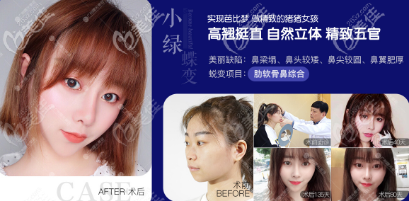 廣州曙光隆鼻案例價(jià)格2900元起