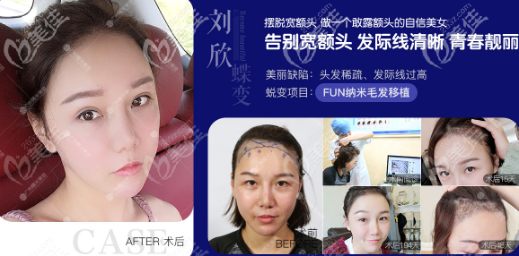 廣州曙光植發(fā)案例價(jià)格6800元起