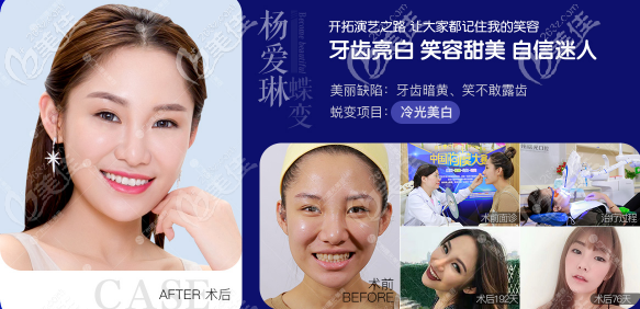 廣州曙光牙齒矯正案例