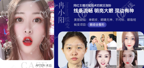 廣州曙光雙眼皮案例價(jià)格3800元起