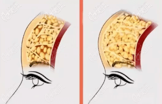 面部脂肪填充過(guò)多示意圖