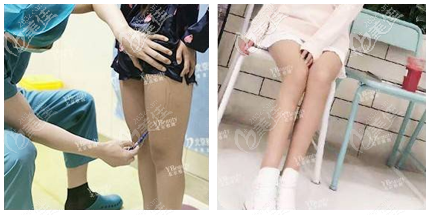 我在北京雅靚做腿部快樂吸脂術(shù)感覺國海軍技術(shù)挺好的