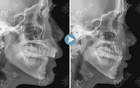 上顎骨突出矯正價格36800-68000元左右 上顎骨突出矯正價格36800-68000元左右