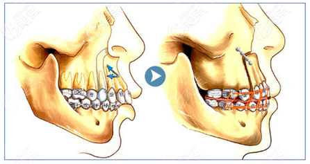 上顎骨突出矯正手術(shù)示意圖 上顎骨突出矯正手術(shù)示意圖