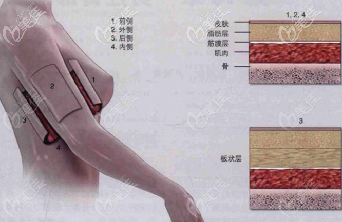 手臂環(huán)吸包含哪幾個部位