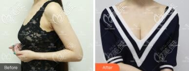 自體脂肪豐胸前后對比照 自體脂肪豐胸前后對比照