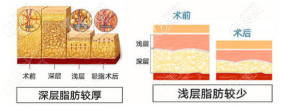 北京南加整形醫(yī)院吸脂技術(shù)優(yōu)勢 北京南加整形醫(yī)院吸脂技術(shù)優(yōu)勢