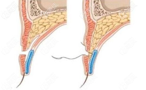 眶隔脂肪釋放術(shù)原理