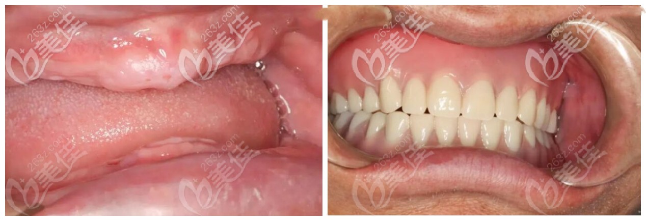 北京勁松口腔全口種植牙前后對(duì)比圖 北京勁松口腔全口種植牙前后對(duì)比圖