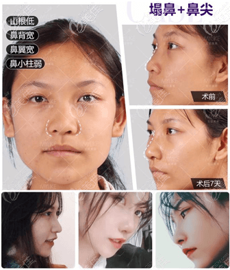 北京美萊做鼻子好的王旭東醫(yī)生半肋鼻綜合案例你覺得怎么樣