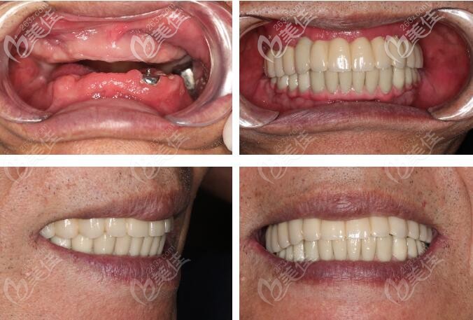 北京牙管家真實(shí)案例分析:長期戴活動義齒會怎樣,還不是做了全口固定種植牙