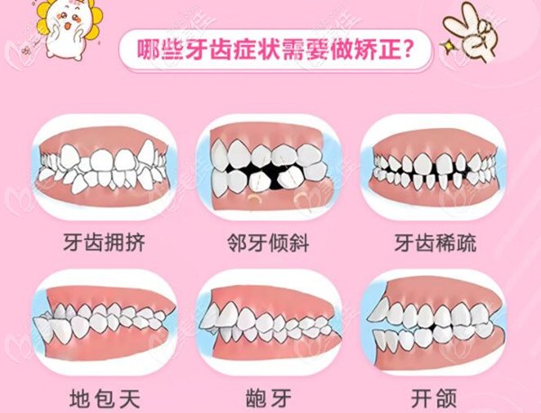 廣州穗江口腔牙齒矯正適應(yīng)癥