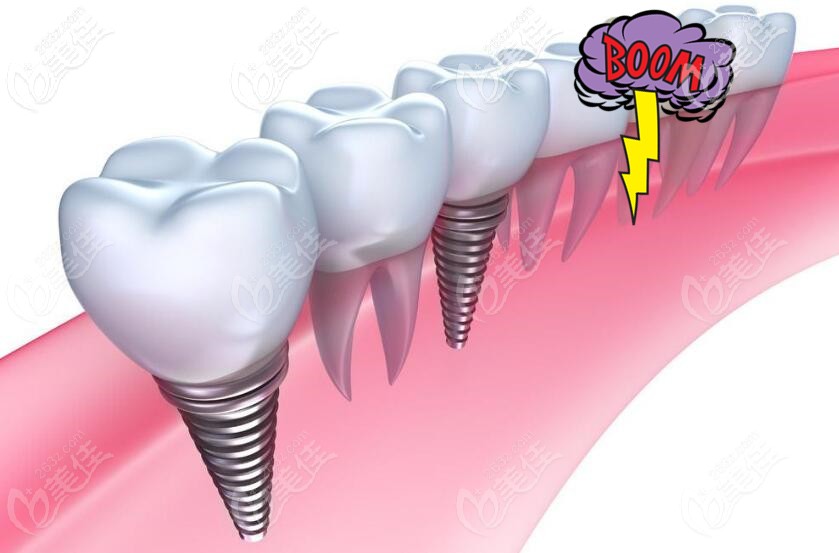 種植牙圖示 種植牙圖示