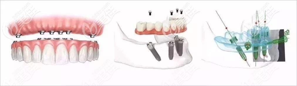 體驗過傳統(tǒng)種植牙的我又體驗了all-on-6半口即刻種植,對比后不得不說效果真贊