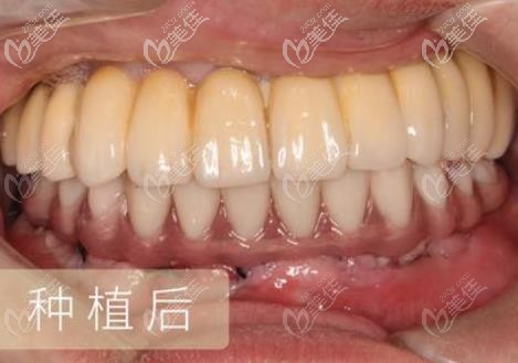 種植牙后的效果圖