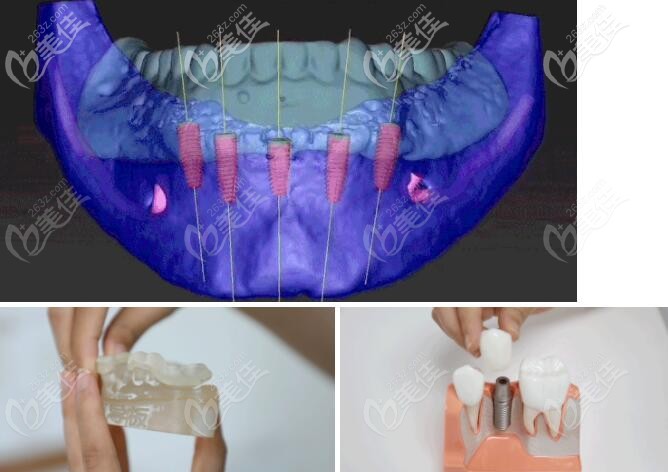 穗江口腔數(shù)字化導(dǎo)板種牙技術(shù)