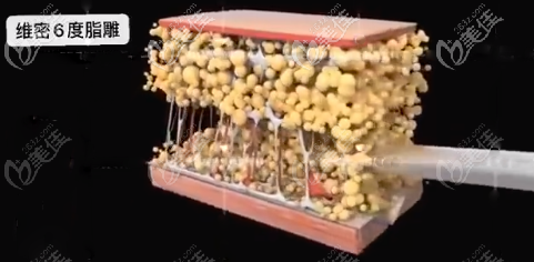 維密6度脂雕吸脂示意圖