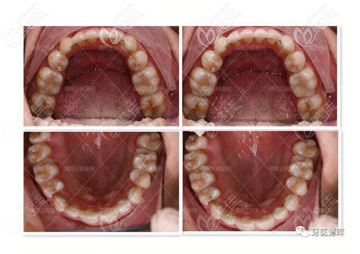 27歲門牙外凸的小哥哥帶鋼牙套矯正兩年后的經(jīng)驗分享