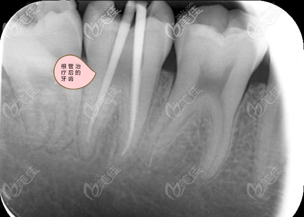 根管治療后的牙齒拍片圖 根管治療后的牙齒拍片圖