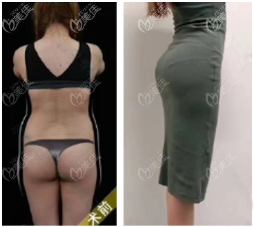 我花6萬多做的維密6°脂雕吸脂瘦腰腹案例效果 我花6萬多做的維密6°脂雕吸脂瘦腰腹案例效果