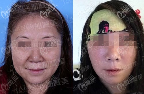 穆寶安V美減齡面部提升案例 穆寶安V美減齡面部提升案例