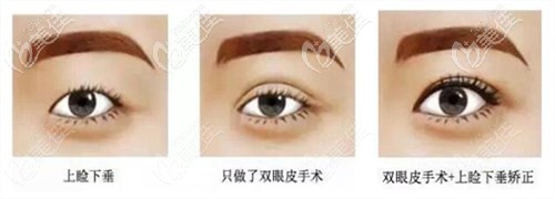 上瞼下垂做提肌和不做提肌的區(qū)別