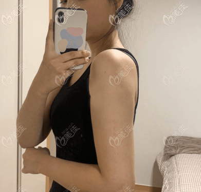 這是我找陳林葉做的手臂吸脂真實案例,術(shù)后十多天恢復(fù)圖呈現(xiàn)給你