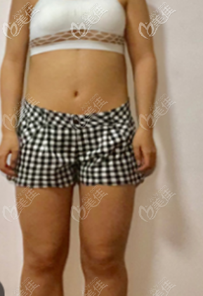 看還沒有做吸脂前胖胖的我 看還沒有做吸脂前胖胖的我