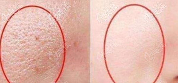 為什么說納米微晶對皮膚好