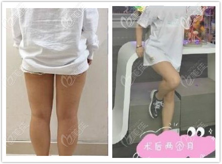 大腿吸脂三個月腿圍細了10厘米