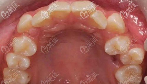 牙齒重度擁擠的圖片 牙齒重度擁擠的圖片