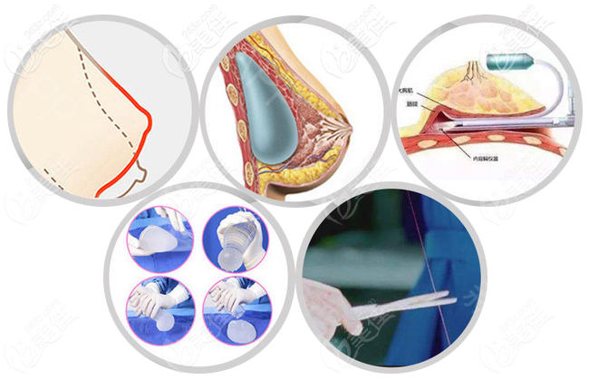 趙宏偉醫(yī)生隆胸技術(shù)怎么樣 趙宏偉醫(yī)生隆胸技術(shù)怎么樣