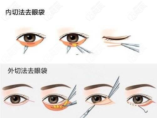 內切和外切去眼袋手術 內切和外切去眼袋手術