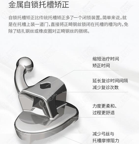 廣州穗江口腔金屬自鎖托槽矯正器 廣州穗江口腔金屬自鎖托槽矯正器