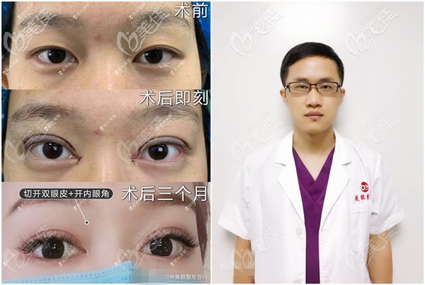 鄭州張行做雙眼皮案例