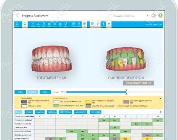 隱形矯正的數(shù)據(jù)要先上傳到云端 隱形矯正的數(shù)據(jù)要先上傳到云端