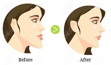 地包天矯正前后動畫對比圖 地包天矯正前后動畫對比圖