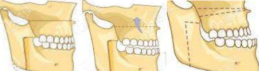 地包天輕微與重度圖片