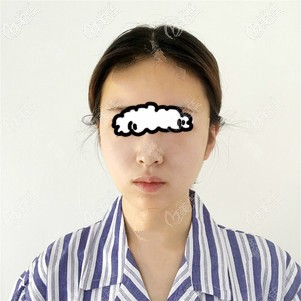 到<!--<i data=20240703-sp></i>-->時(shí)光自體脂肪填充臉部前照片 到<!--<i data=20240703-sp></i>-->時(shí)光自體脂肪填充臉部前照片