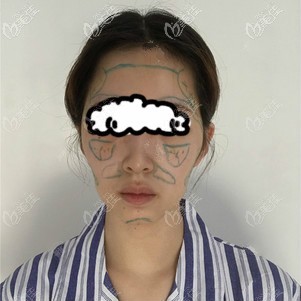 <!--<i data=20240703-sp></i>-->時(shí)光王彬做脂肪填充臉部劃線樣子 <!--<i data=20240703-sp></i>-->時(shí)光王彬做脂肪填充臉部劃線樣子