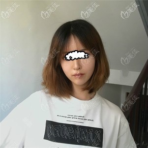 <!--<i data=20240703-sp></i>-->時(shí)光王彬自體脂肪填充臉部10天臉好丑 <!--<i data=20240703-sp></i>-->時(shí)光王彬自體脂肪填充臉部10天臉好丑