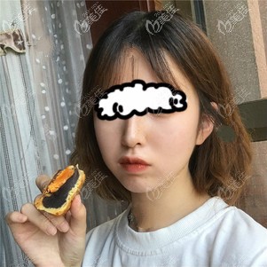 去<!--<i data=20240703-sp></i>-->時(shí)光做臉部自體脂肪填充45天效果圖 去<!--<i data=20240703-sp></i>-->時(shí)光做臉部自體脂肪填充45天效果圖