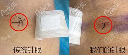 綿陽朗睿的吸脂優(yōu)勢 綿陽朗睿的吸脂優(yōu)勢