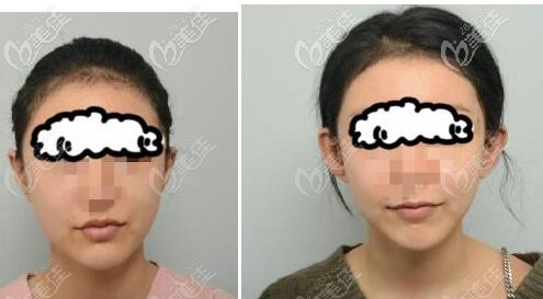 貼發(fā)耳矯正前后對比照