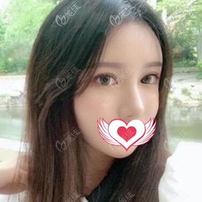 大連沙醫(yī)生整形吳紫權(quán)雙眼皮修復(fù)真人案例：術(shù)后2個月效果對比照展示！